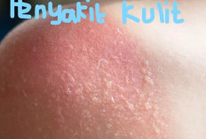 8 Penyebab Timbulnya Penyakit Kulit
