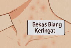 5 Cara Mengatasi Bekas Biang Keringat yang Parah