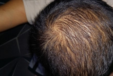 Penyebab Rambut Rontok yang Perlu Perhatian