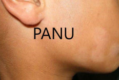 6 Penyebab Anak Mudah Panuan