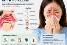 Rhinitis Gangguan Hidung yang Sering Dianggap Sepele, Ini Cara Mengatasinya