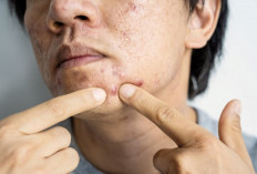 7 Makanan yang Memicu Timbulnya Jerawat Pada Wajah
