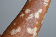 Apa Itu Vitiligo?