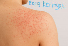 5 Cara Meredakan Biang Keringat Lebih Cepat